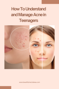 How To Understand and Manage Acne in Teenagers