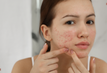 Understanding and Managing Acne: A Guide for Teenage Girls and Their Parents