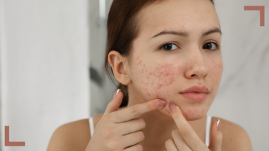 Understanding and Managing Acne: A Guide for Teenage Girls and Their Parents