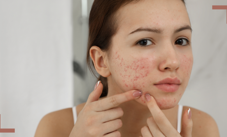 Understanding and Managing Acne: A Guide for Teenage Girls and Their Parents