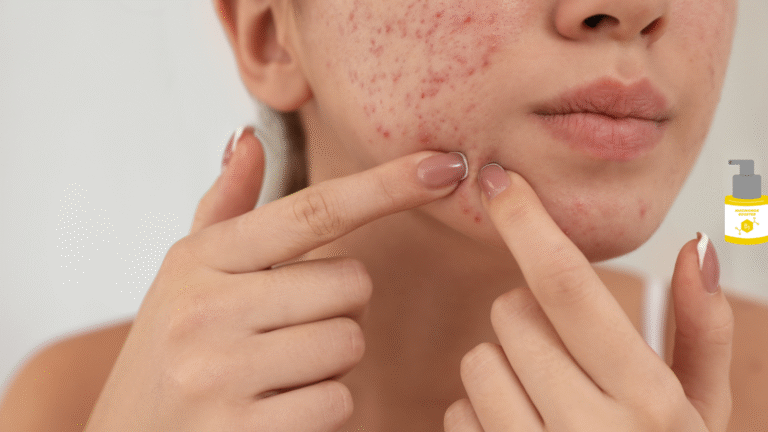 7 Powerful Ingredients That Can Fade Acne Scars
