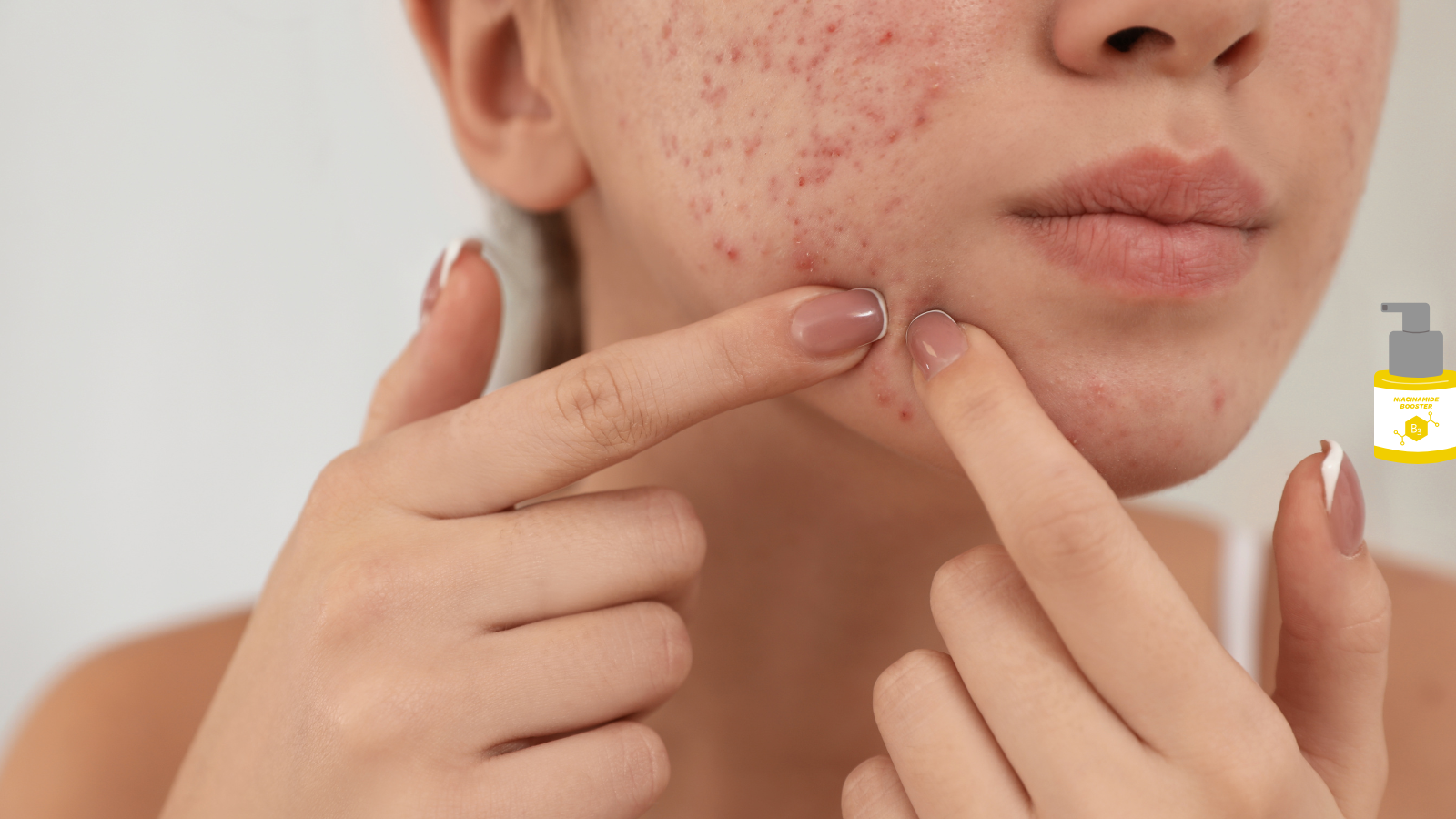 7 Powerful Ingredients That Can Fade Acne Scars
